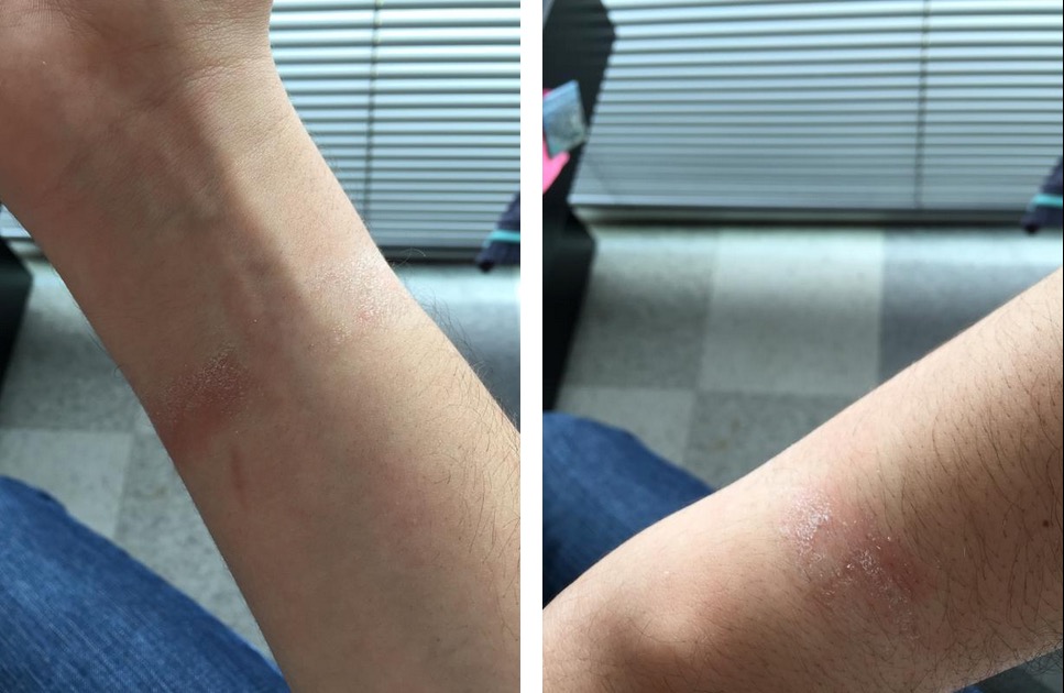 Apple Watch Causes Skin Irritation, Allergic Reactions for Some Users [Photos]