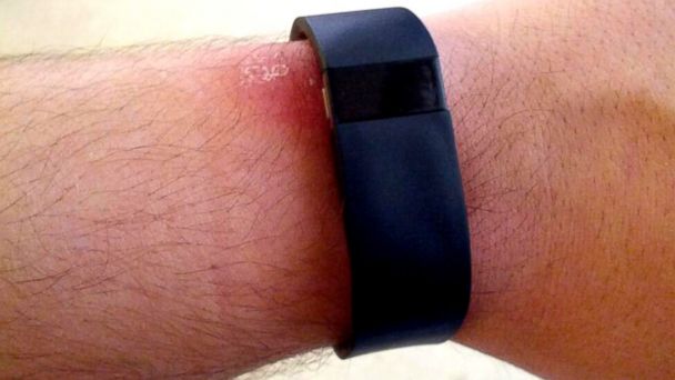 Fitbit Announces Voluntary Recall of Fitbit Force Due to Skin Irritation Complaints