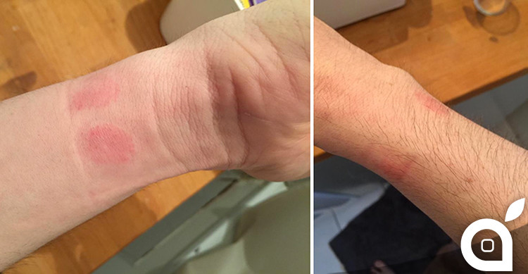 Apple Watch Causes Skin Irritation, Allergic Reactions for Some Users [Photos]