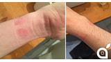 Apple Watch Causes Skin Irritation, Allergic Reactions for Some Users [Photos]