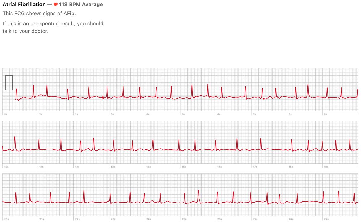 Afib Ekg Chart